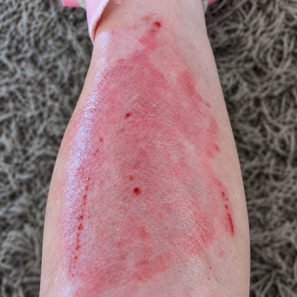 Customers leg before using red light therapy. Clearly red, inflamed and irritated.