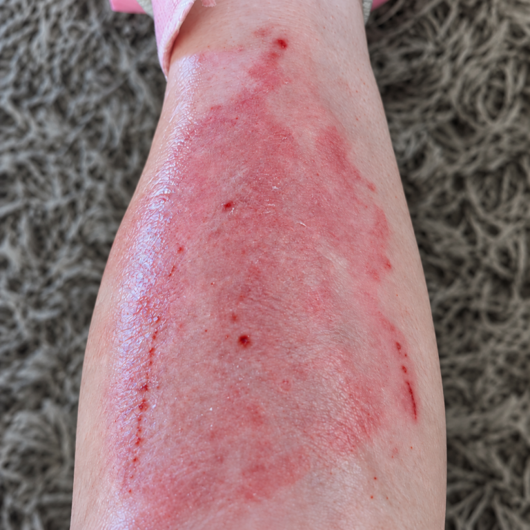 Customers leg before using red light therapy. Clearly red, inflamed and irritated.